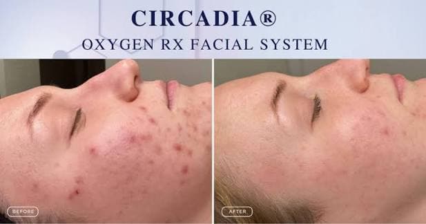 OXYGEN RX Treatment mit Cocoa Enzyme bei EM Beauty – Haus der Orchidee